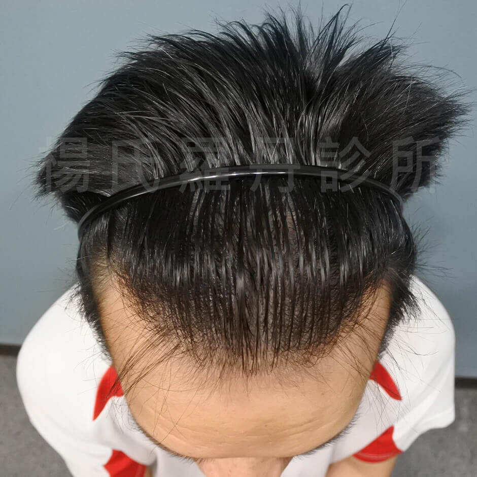 禿頭 植髮 ARTAS 掉髮